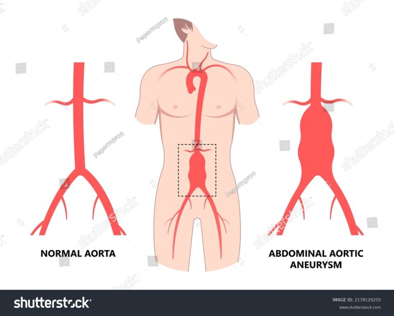 Abdominal Aortic Aneurysm