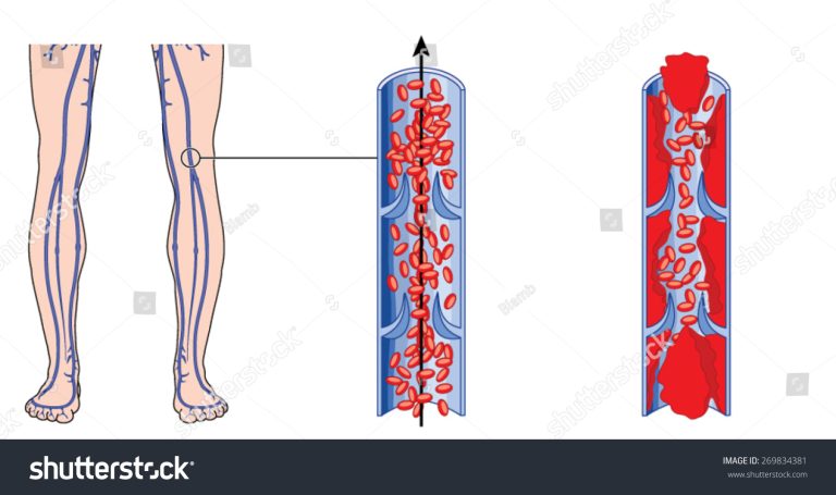 Deep Vein Thrombosis