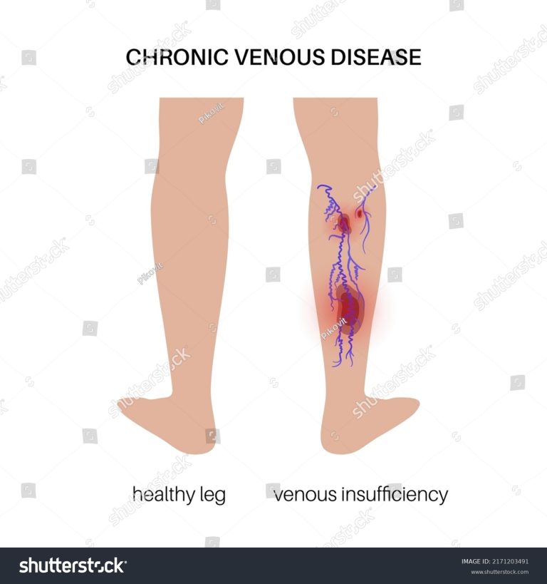 Chronic Venous Insufficiency